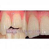 ماده ترمیمی و زیبایی bisico ماده ترمیمی و زیبایی bisico